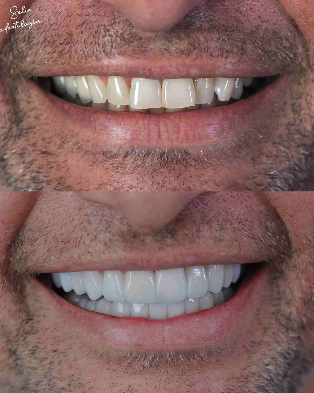 Antes e Depois SELIV 1
