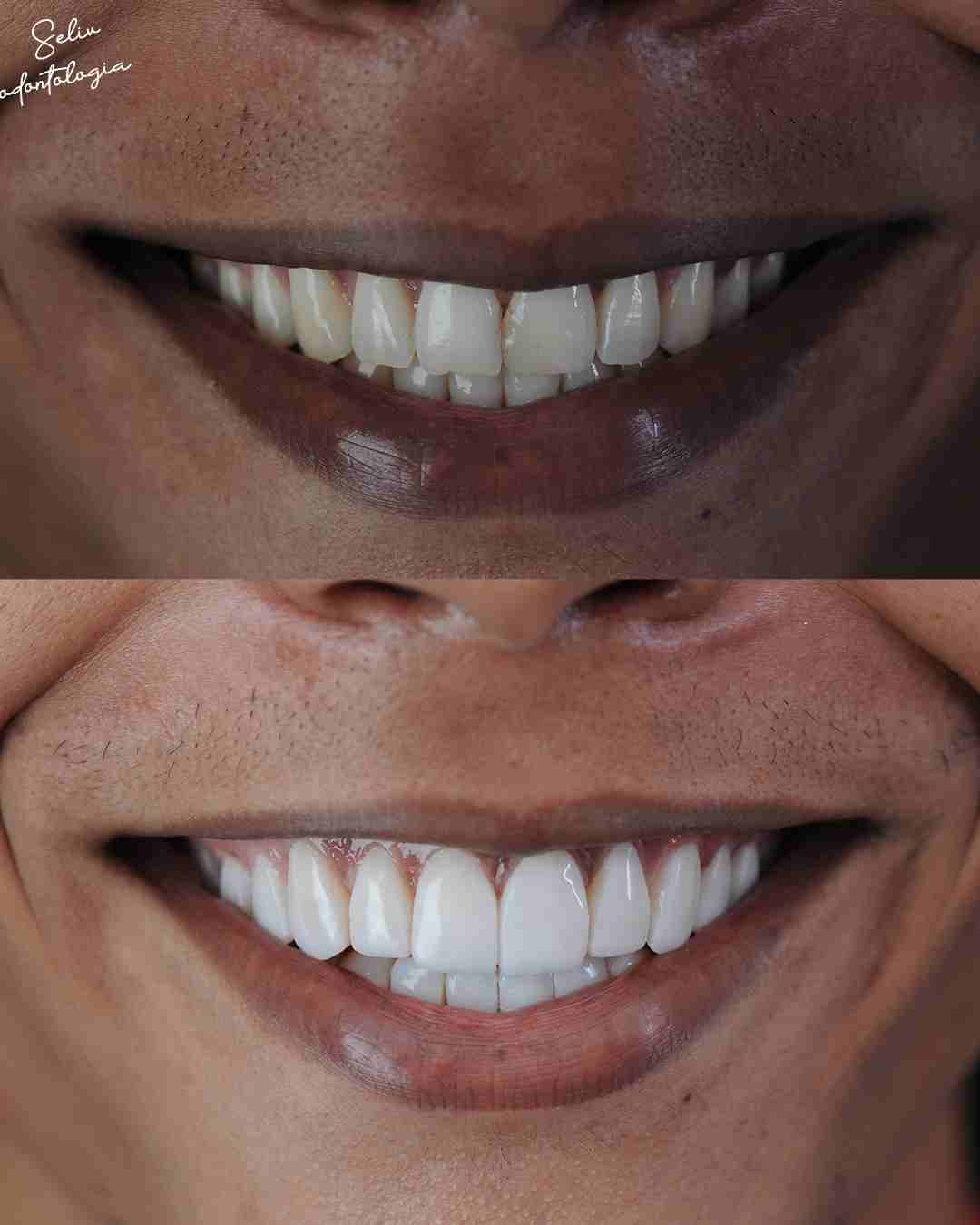 Antes e Depois SELIV 2