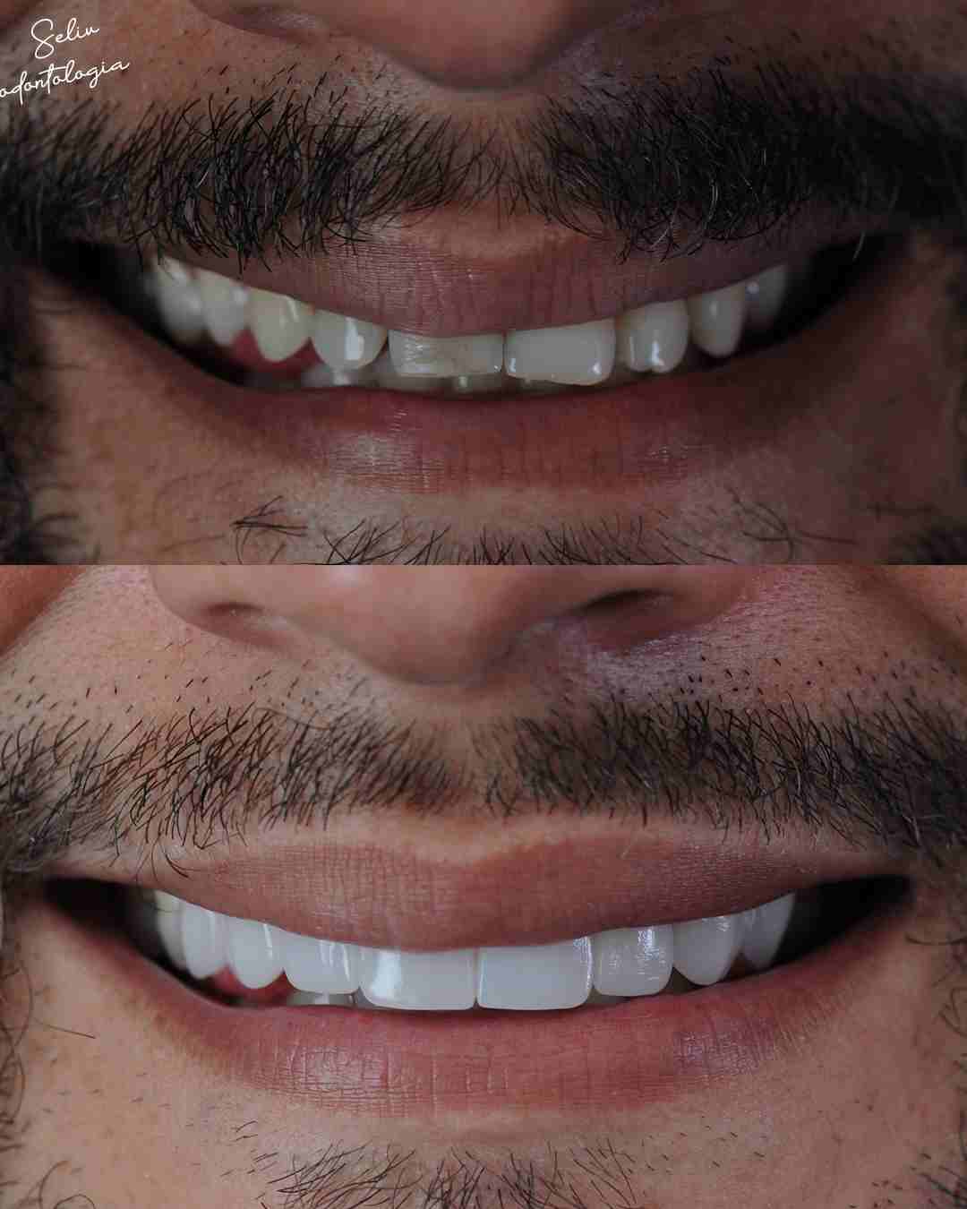 Antes e Depois SELIV 3