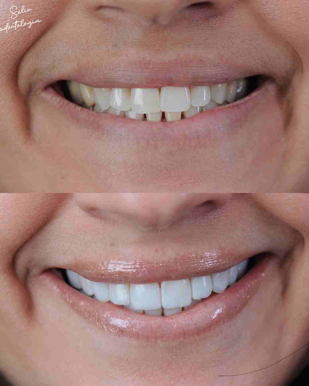 Antes e Depois SELIV 4