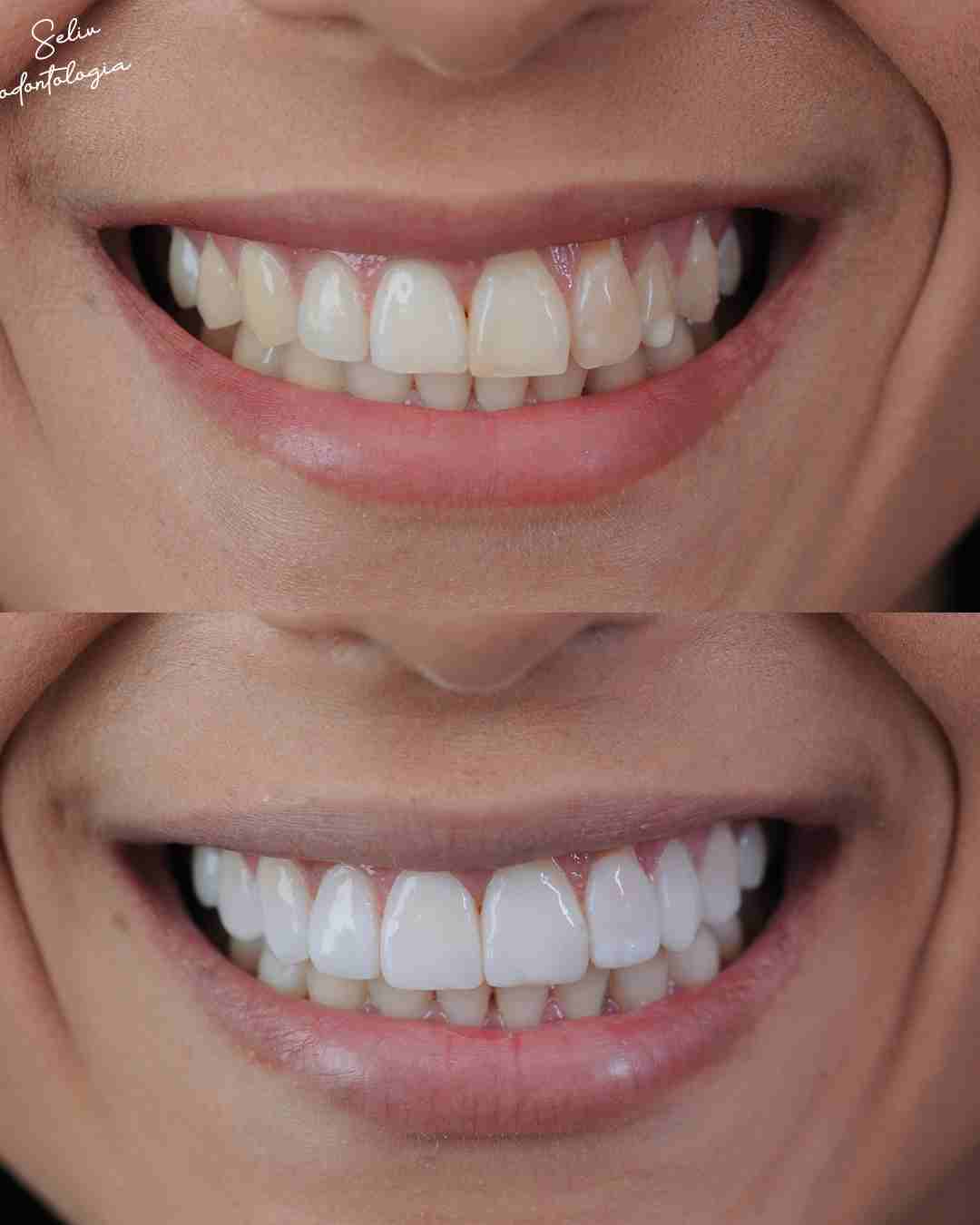 Antes e Depois SELIV 5