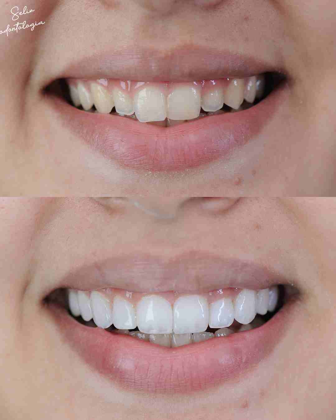 Antes e Depois SELIV 6