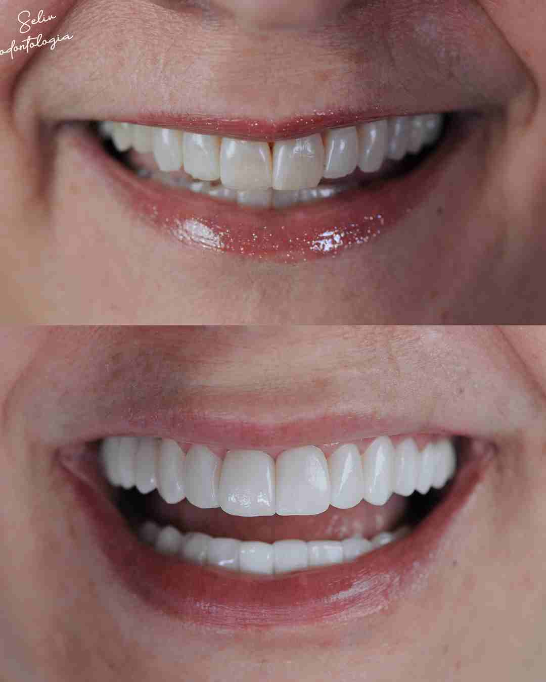 Antes e Depois SELIV 7