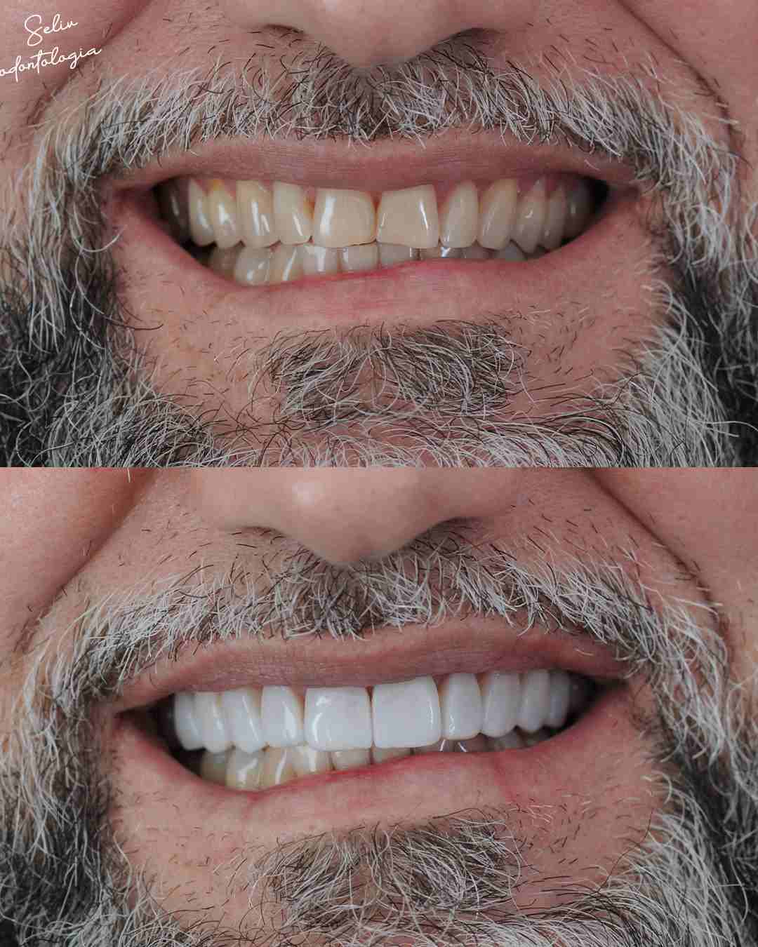 Antes e Depois SELIV 8